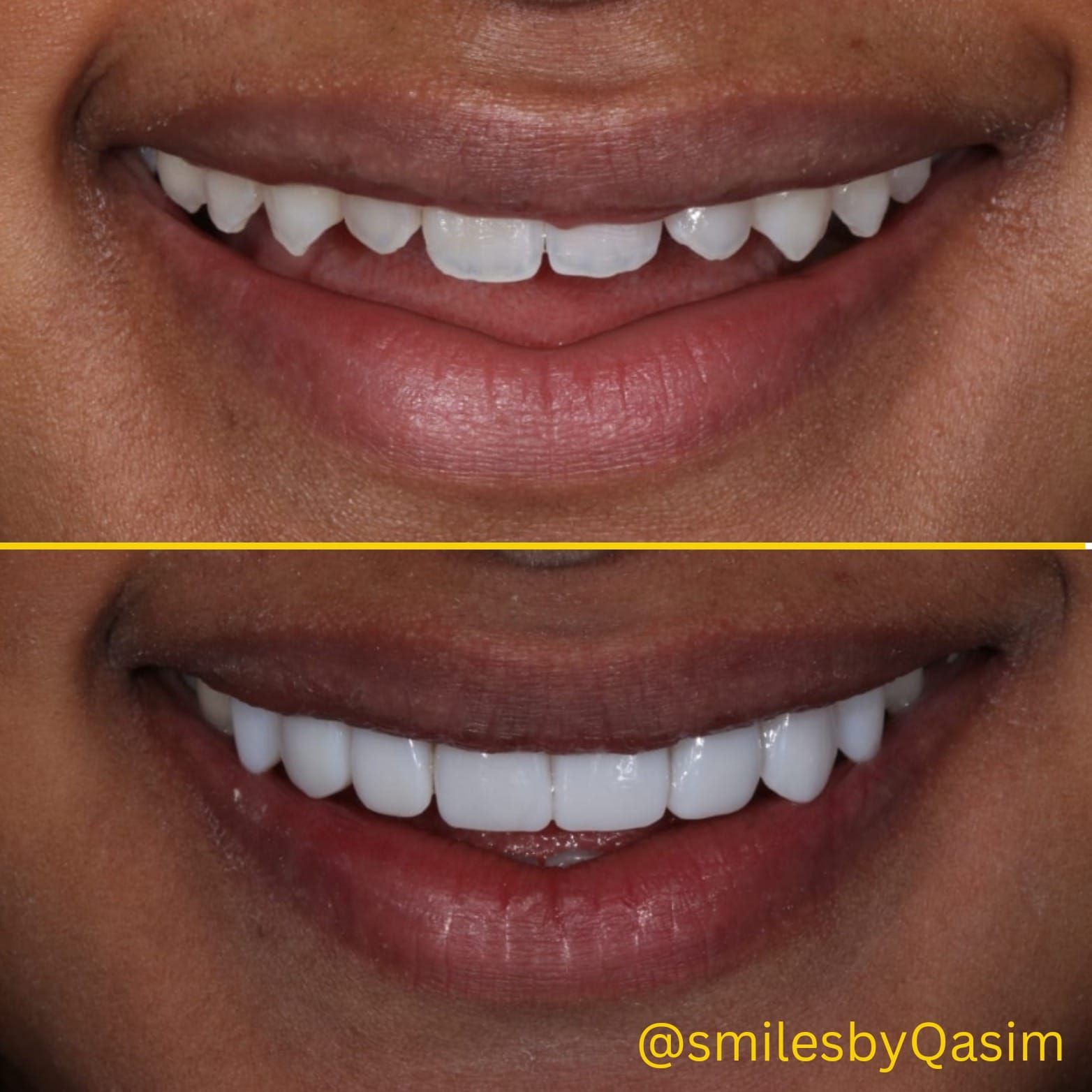 Composite bonding smile case 5