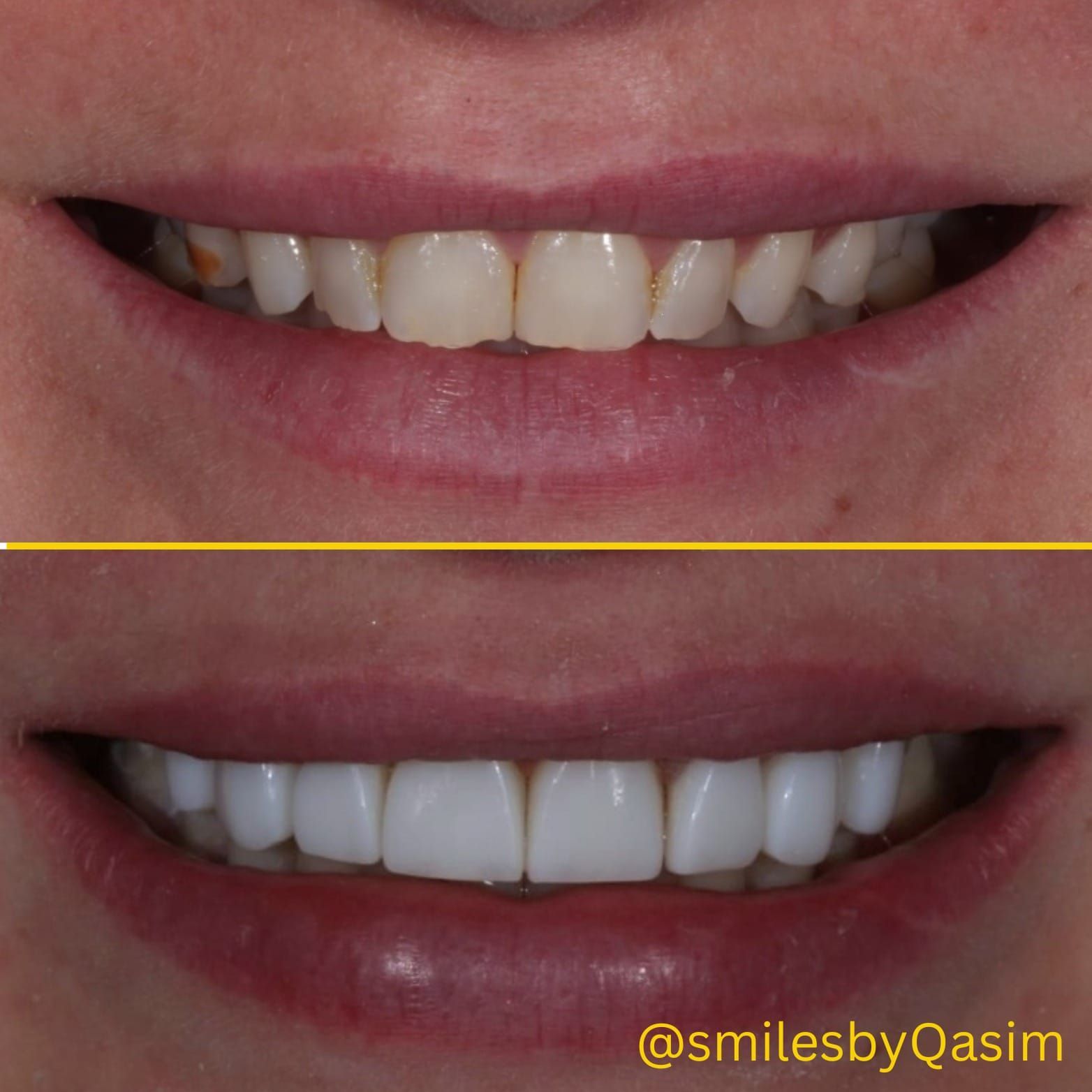 Composite bonding smile case 4