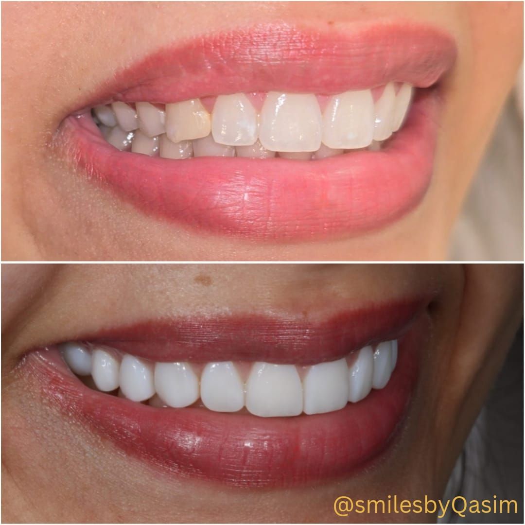 Composite bonding smile case 3