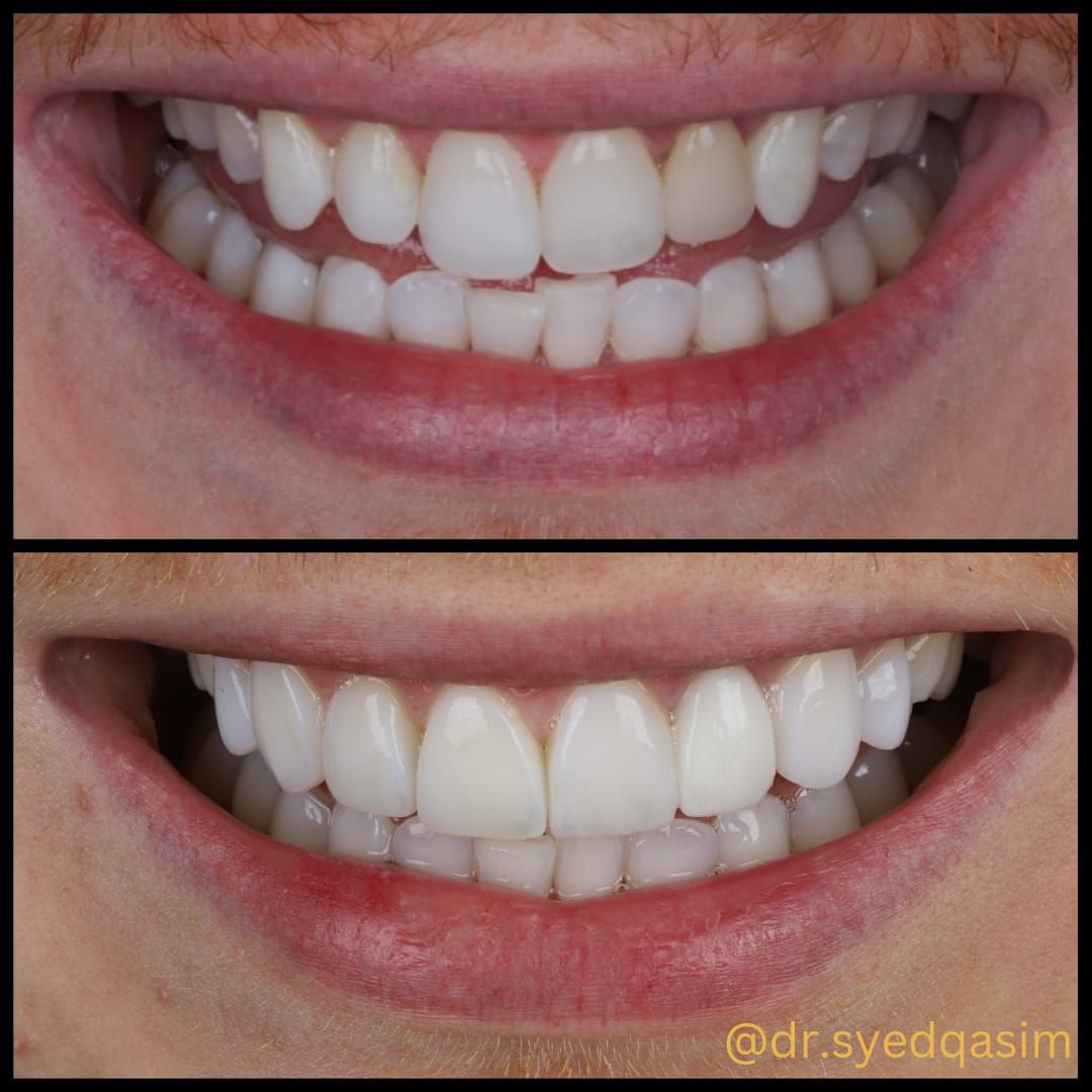 Composite bonding smile case 2
