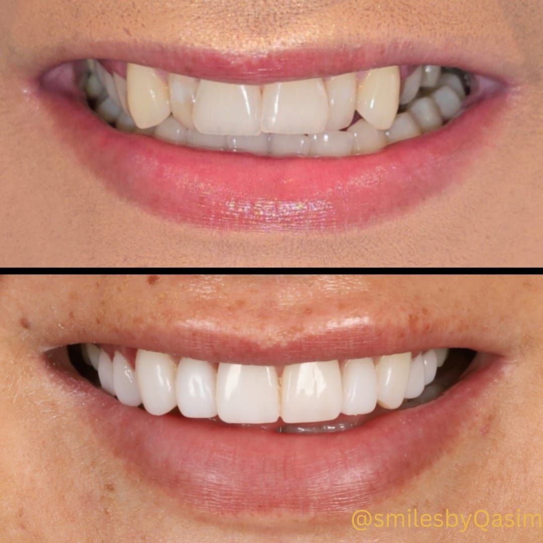 Composite bonding smile case 1