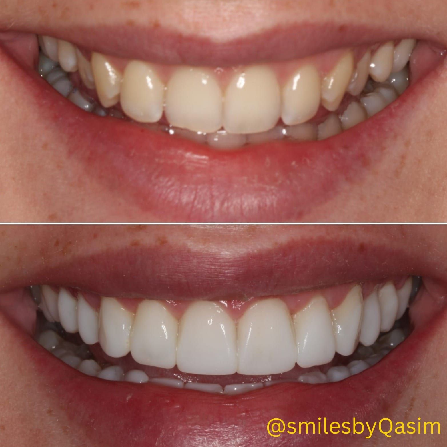 Composite bonding smile case 6